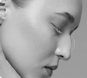 تزریق فیلر بینی جهت اصلاح فرم - قبل از درمان